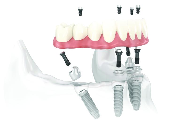 Зубная хирургия и имплантация